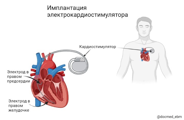 При наличии кардиостимулятора можно. Имплантация кардиостимулятора. Двухкамерный кардиостимулятор. Наружный кардиостимулятор. Однокамерный кардиостимулятор.